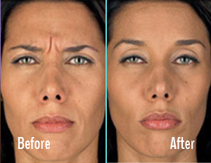Botox Before After Case 02