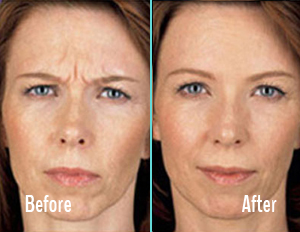 Botox Before After Case 03