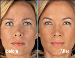 Botox Before After Case 04