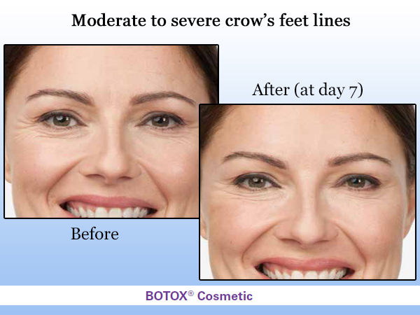 Dr. Roberts Cosmetic Boutique Birmingham - Before and After Botox Image