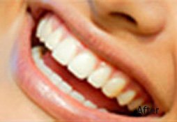 Dental Filling After Image 01