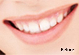 Dental Filling After Image 02