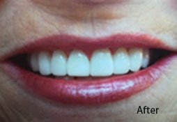 Dental Filling After Image 03