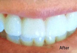 Dental Filling After Image 04