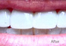 Dentures After Image 01