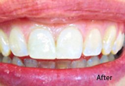 Dental Filling After Image 06