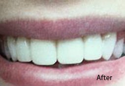 Dental Filling After Image 08