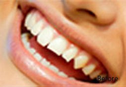Dental Filling Before Image 01