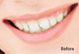 Dental Filling Before Image 02