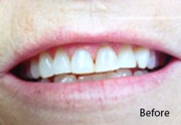 Dental Filling Before Image 03