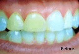 Dental Filling Before Image 04