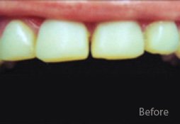 Dentures Before Image 01