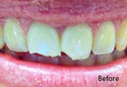 Dental Filling Before Image 06