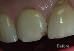 Dental Filling Before Image 07