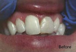 Dental Filling Before Image 08