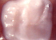 No Drilling Fillings Willoughby Hills - Tooth Restored