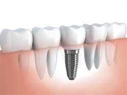 Dental Implants Willoughby Hills - Dental Implant in photo