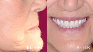 Before and After Dental Implant 02