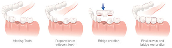 Dental Bridges