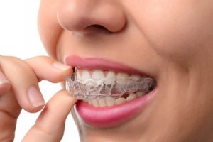 Invisalign Invisalign provider