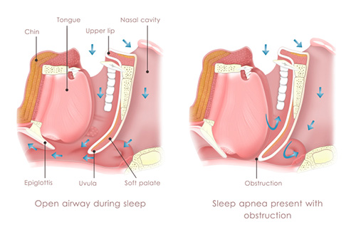 Sleep Apnoea