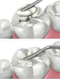 White Fillings