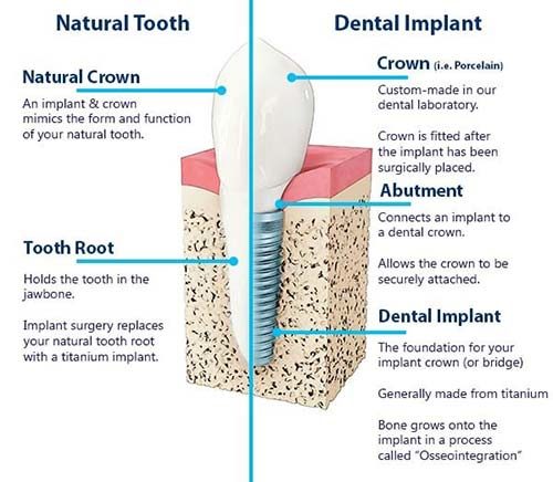 The benefits of dental implants are important to understand.