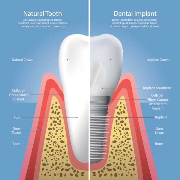 Dental Implant in Detail