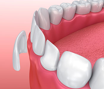 Veneers