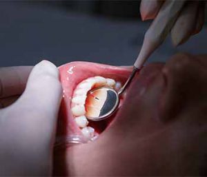 Dr. Khieu Anh at Tyrone Family Dentistry explains about Root canal therapy to the rescue.