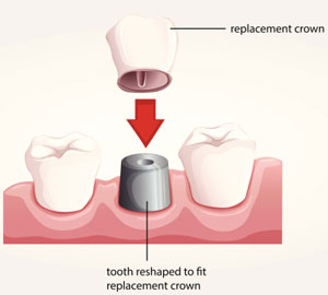 cerec-same-day-crowns