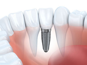 dental-implant