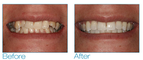 invisalign-and-6-month-smiles-1