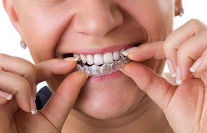 invisalign-and-6-month-smiles