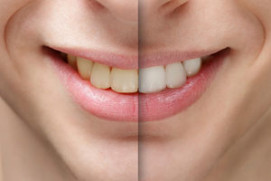 smile-makeover