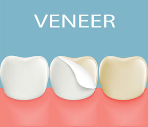 veneers
