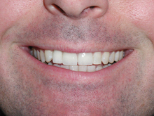 Implant and veneers After