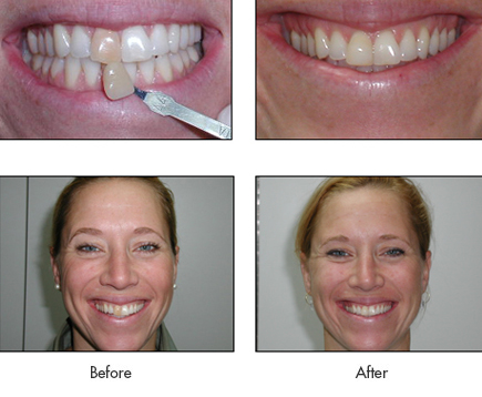 Before and After - Jesica
