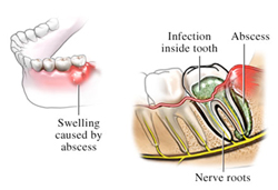 Abscessed Tooth Chicago - Mouth