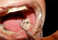 Sealants Chicago - Mouth