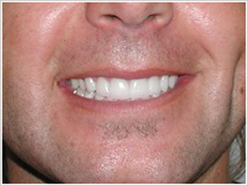 Veneers For Teeth Chicago - After