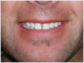 Veneers For Teeth Chicago - Before