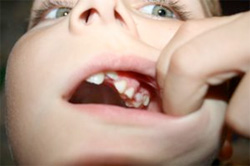Broken Tooth Chicago - Mouth