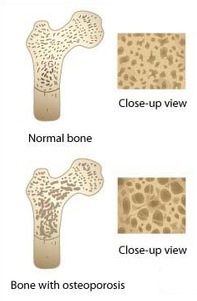 Osteoporosis Chicago - Bone