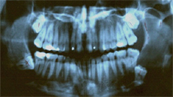 Impacted Wisdom Teeth - X-ray