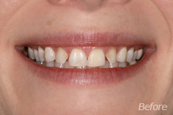 Snap on Smiles Chicago - Before