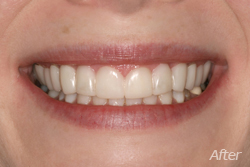 Snap on Smiles Chicago - After