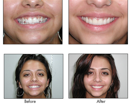 Before and After - Jesmine
