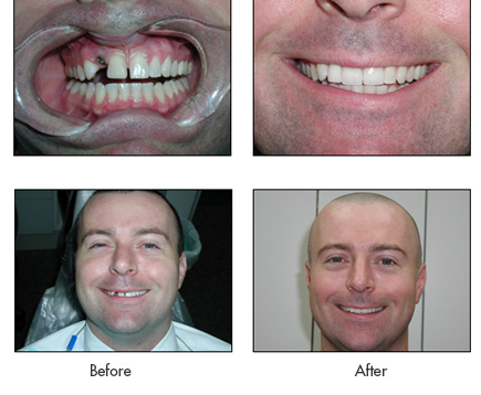 Michael - Before and After