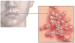 Canker Sores Chicago - Cavities